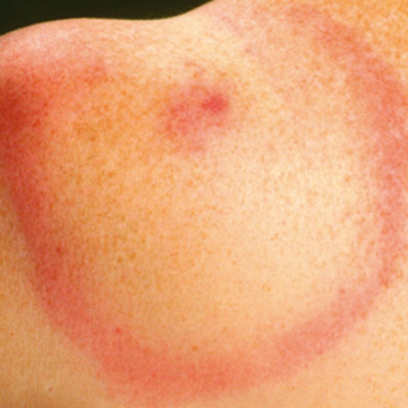 Rode kring op huid door de ziekte van Lyme.